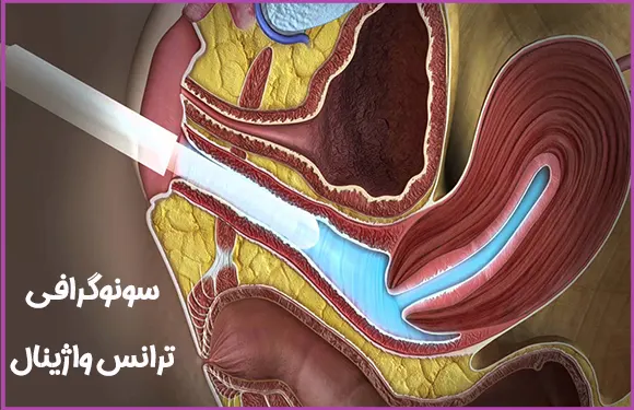سونوگرافی ترانس واژینال