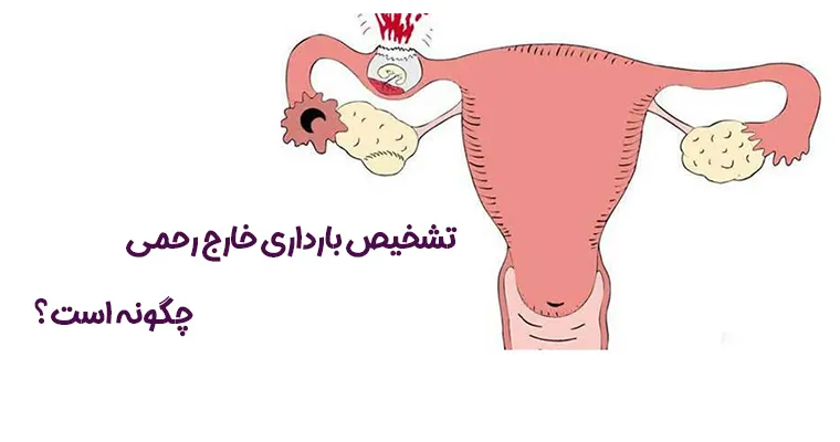 تشخیص بارداری خارج رحمی