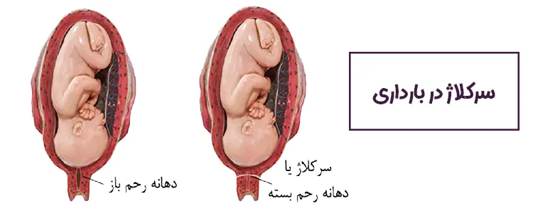 سرکلاژ رحم