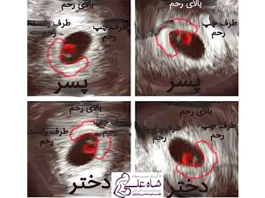 تعیین جنسیت جنین