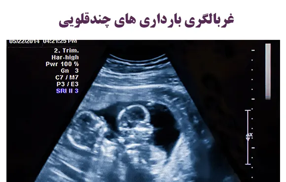 غربالگری بارداری های چندقلویی