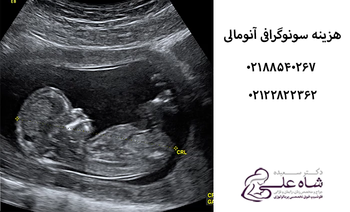 هزینه سونو انومالی در تهران