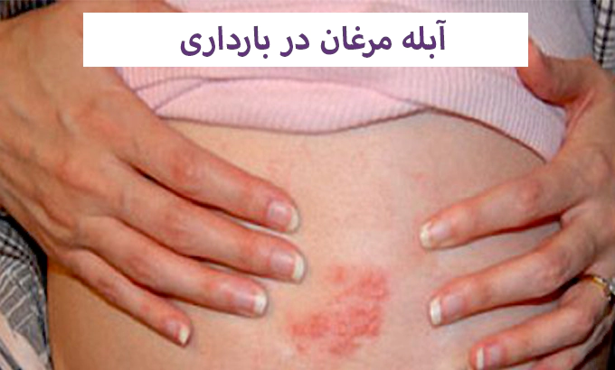 آبله مرغان در بارداری
