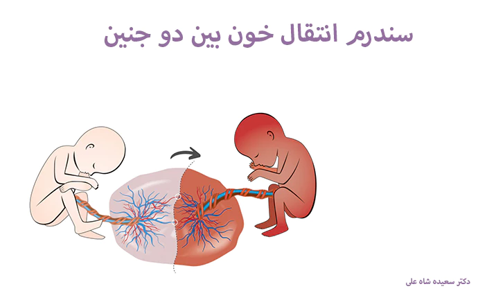 سندرم انتقال خون بین دو جنین