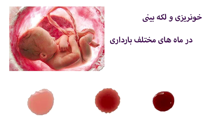خونریزی در اوایل بارداری