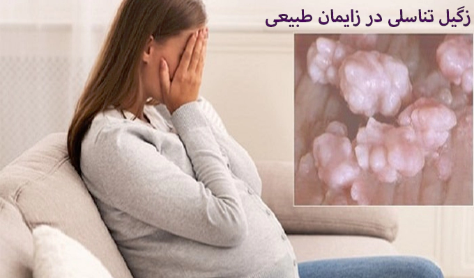 زکیل تناسلی در زایمان طبیعی