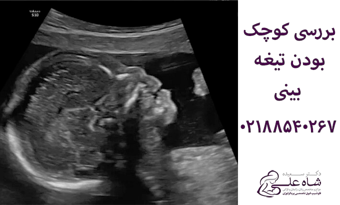 کوچک بودن تیغه بینی