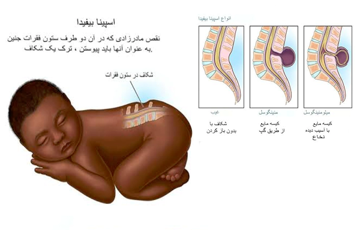 اسپینا بیفیدا جنین در بارداری