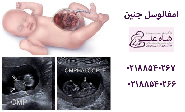 امفالوسل جنین