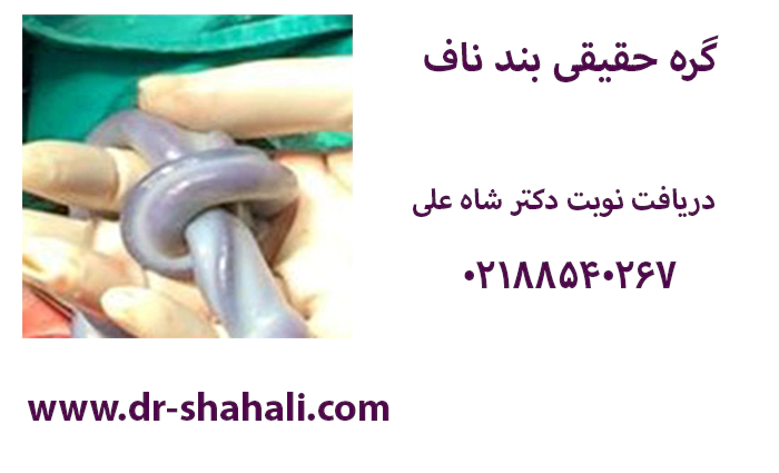 گره حقیقی بند ناف