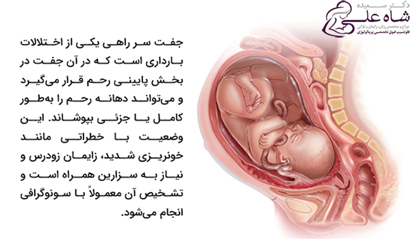 جفت سراراهی یعنی چی؟