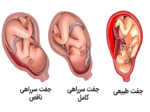 جفت سرراهی ناقص