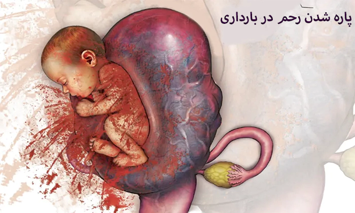 پارگی رحم در حاملگی